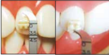 Bracket Tweezers (YDM)