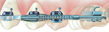 Lancer Lokar Molar Distiliser (10 Pack)